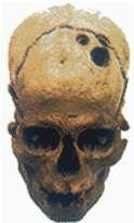 Cráneo de hombre primitivo mostrando dos orificios por trepanación. Pulsa aquí para saber más.